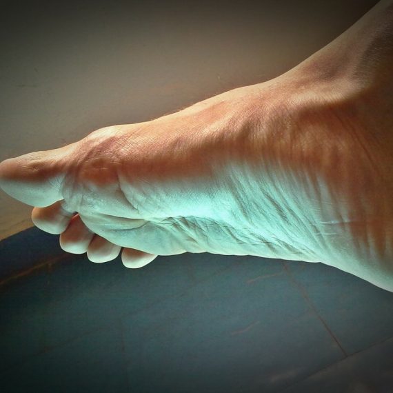 plantar fasciitis foot