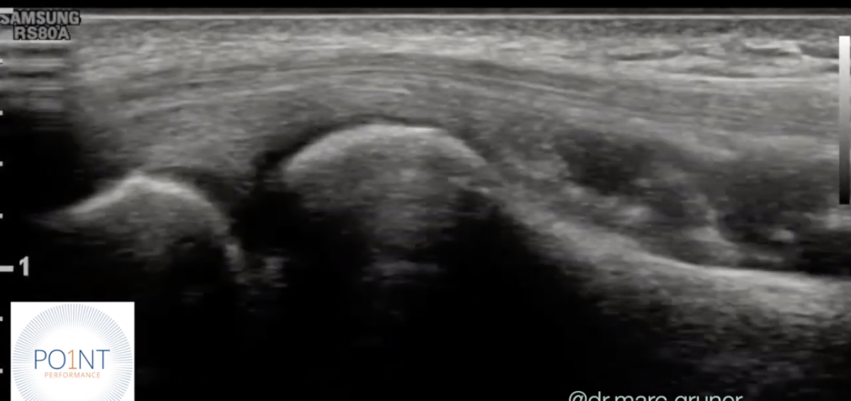 tennis elbow ultrasound