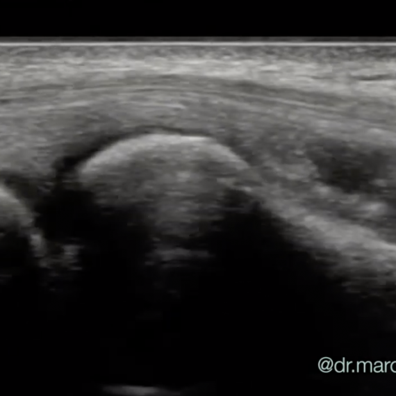 tennis elbow ultrasound
