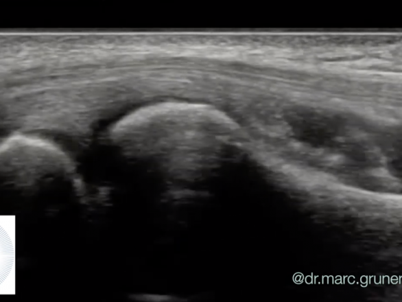 tennis elbow ultrasound