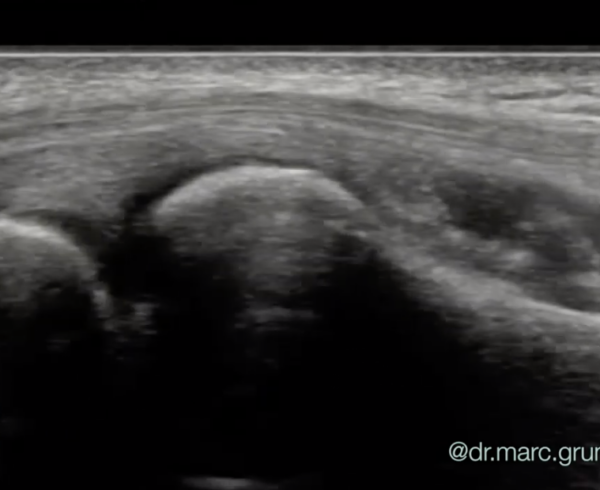 tennis elbow ultrasound