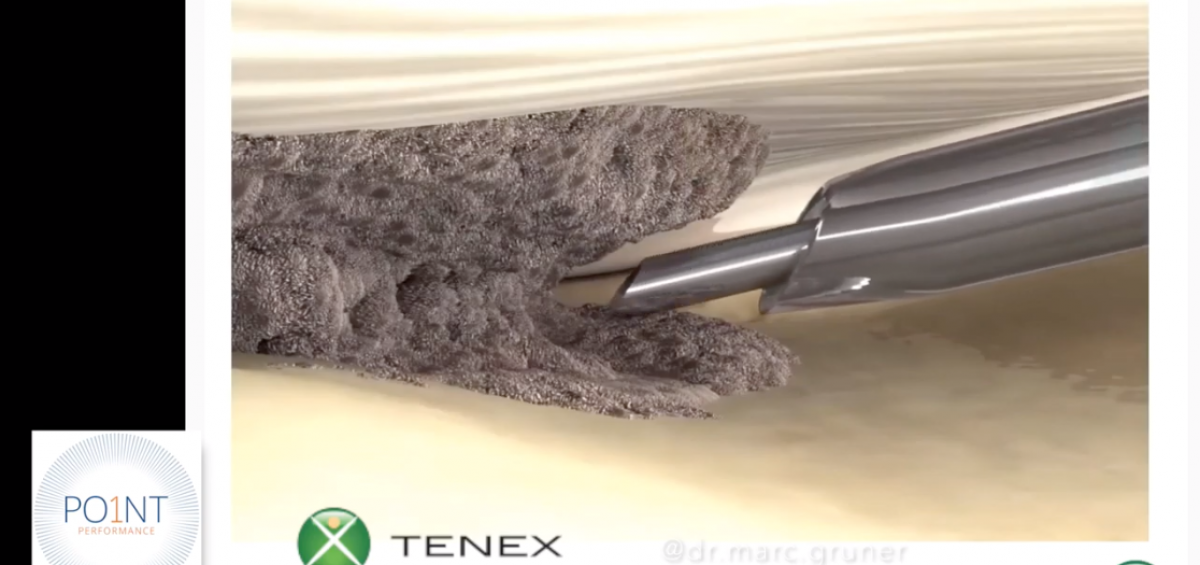 Tenex technology procedure