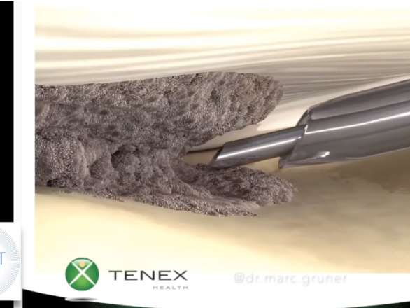 Tenex technology procedure